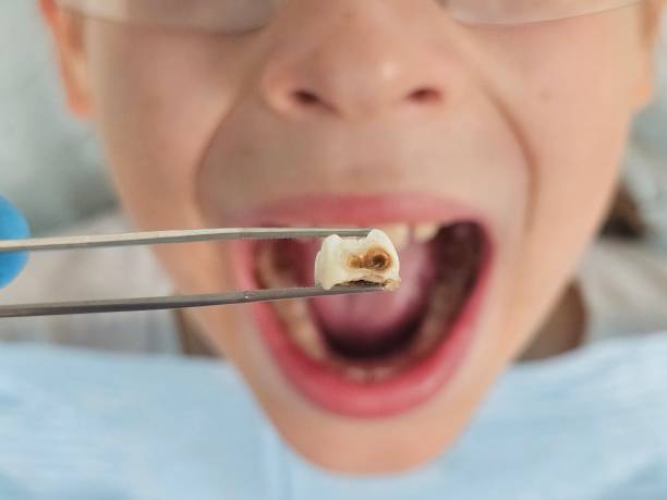Best Emergency Dentist for Lost Fillings or Crowns in Federal Y, WA